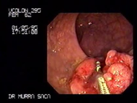 The Sequence Polyp - Carcinoma