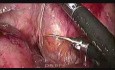 Laparoscopic Hartmann Reversal