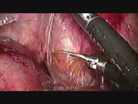 Laparoscopic Hartmann Reversal