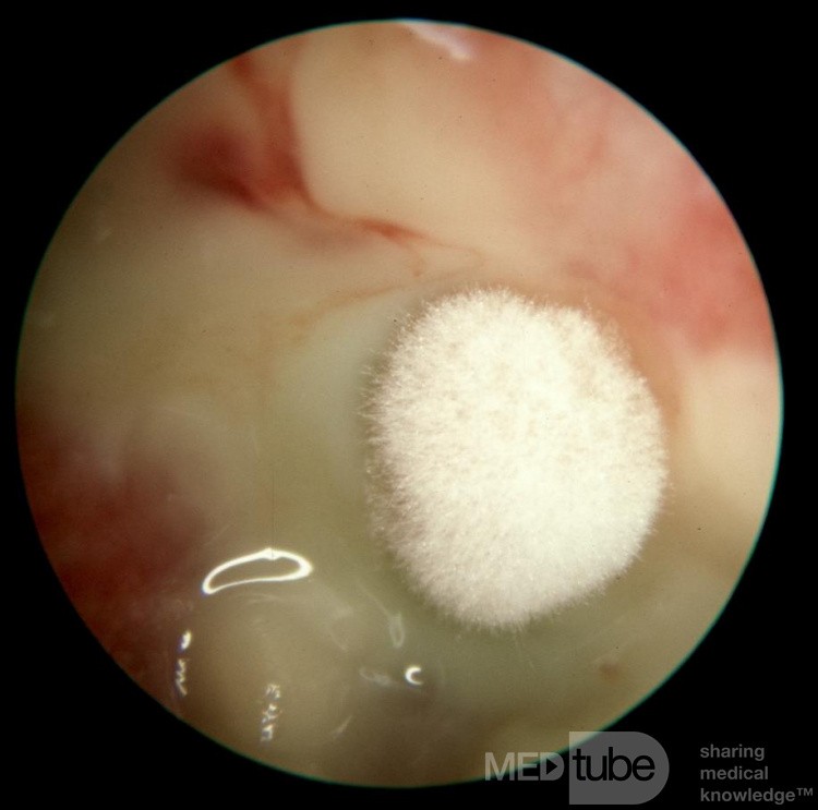 Mixed Bacterial and Fungal Otitis Externa