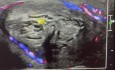 Avascular Rt Testis after Neglect Torsion