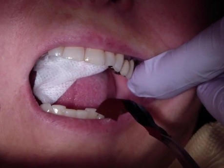 Bridge Insert: Use Vaseline To Check Occlusion.Mp4