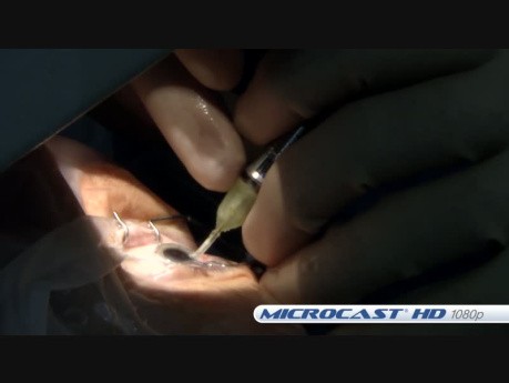 Posterior Ophthalmic Retina Microsurgery