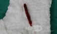 Branchial Fistula Surgery Two Step Incision