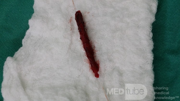 Branchial Fistula Surgery Two Step Incision