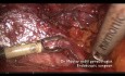 Vascular injury during complex hysterectomy