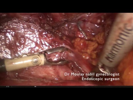 Vascular injury during complex hysterectomy