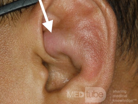 Seroma of The Pinna