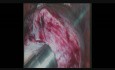Total Laparoscopic Hysterectomy of Fibroid with Morcelation
