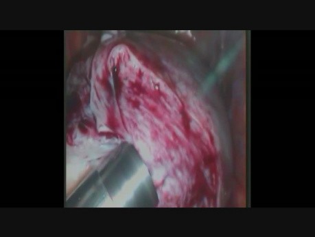 Total Laparoscopic Hysterectomy of Fibroid with Morcelation