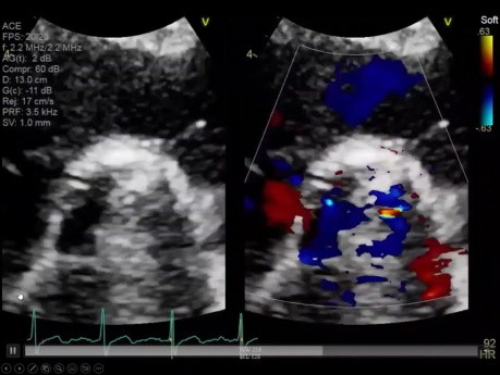 Echocardiographic Assessment of Prosthetic Valves