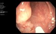 Colon Lateral Spreading Tumor Resected by EMR
