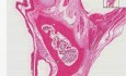 Benign teratoma - Histopathology of ovary