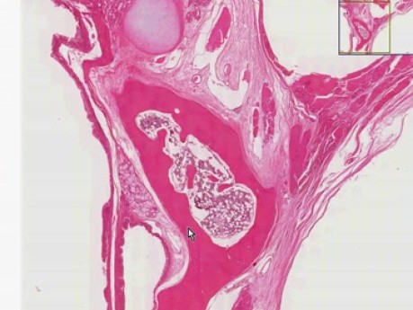 Benign teratoma - Histopathology of ovary