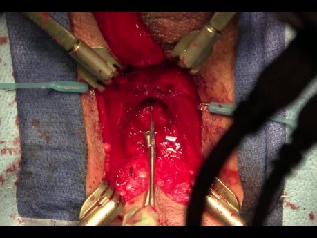 Posterior Urethroplasty For Pelvic Fracture Urethral Injury 