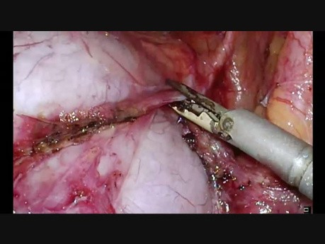 TLH Huge Broad Ligament Fibroid