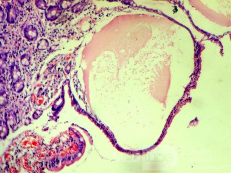 Duodenal lymphangiectasia (7 of 7)