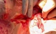 En Block Resection of Heart and Lung and Esophagus 