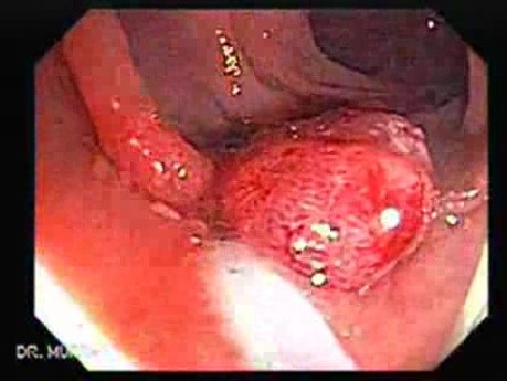 Endoscopic Appearance of Pedicled Polyp of the Descending Colon (4 of 7)