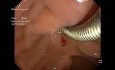 Ampullectomy Part V