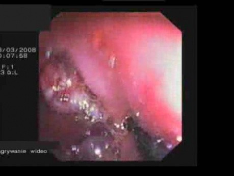 Endoscopic Removing Of Stomach Polyps