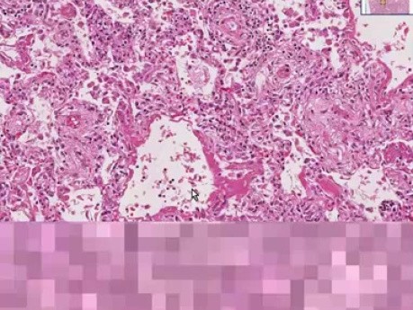 Diffuse alveolar damage
