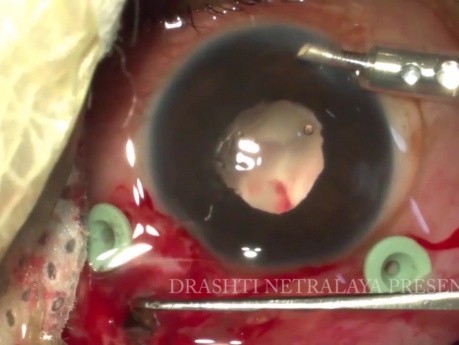 Babool Thorn in Eye