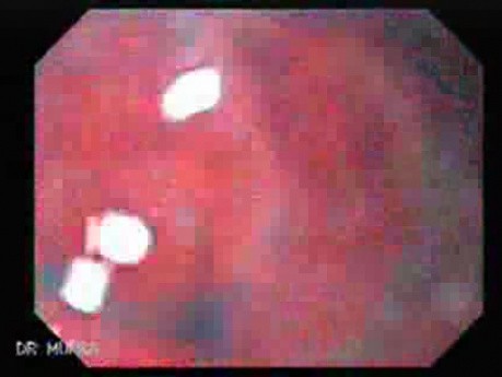 Scirrhous Gastric Carcinoma - High Magnification Endoscopy (5 of 15)