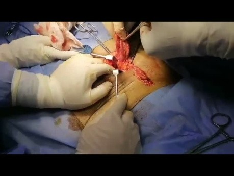 Femoral Hernia - Inguinal Approach