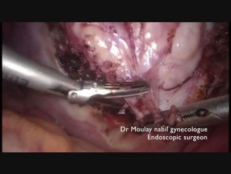Blood Sparing Laparoscopic Myomectomy