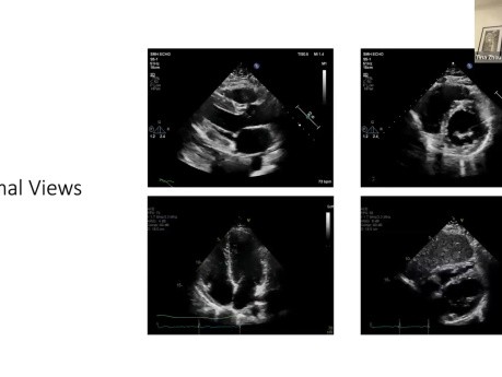 Echocardiography Normal Variants in the Eyes of the Beholder