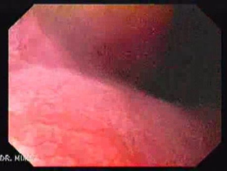 Longstanding gastroesophageal reflux disease -magnifying endoscopy (6 of 7)