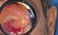 Superotemporal Branch Retinal Vein Occlusion