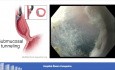 Peroral Endoscopic Myotomy (POEM) for Treatment of Hypercontractile Esophageal Disorders