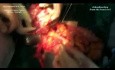 Multifocal Abdominal Sarcoma Surgical Treatment