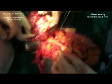 Multifocal Abdominal Sarcoma Surgical Treatment