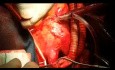 Aortic Arch Debranching for Zone Zero Aortic Dissection