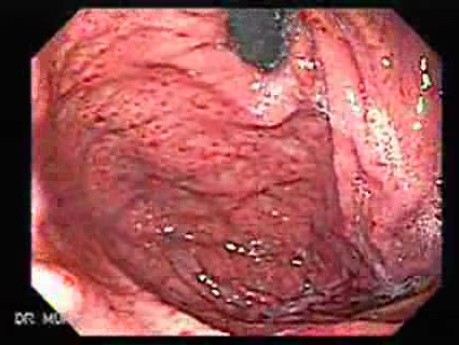 Acute Gastritis (5 of 6)