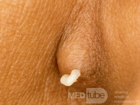 Epidermal Cyst