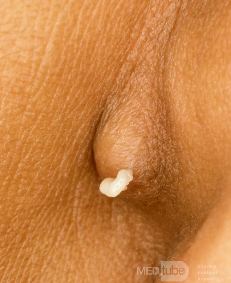 Epidermal Cyst