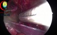 Clipping Fascia Transverslis to the Periosteum of Superior Pubic Ramus to avoid the development of phantom hernia