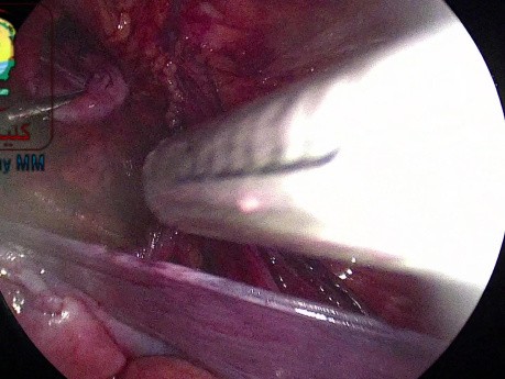 Clipping Fascia Transverslis to the Periosteum of Superior Pubic Ramus to avoid the development of phantom hernia