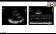 Echocardiography: Normal Variants in the Eyes of the Beholder