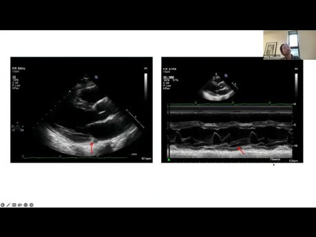 Echocardiography: Normal Variants in the Eyes of the Beholder