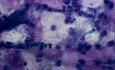 Vaginitis - Streptococcus