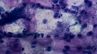 Vaginitis - Streptococcus