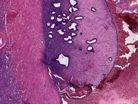 Endometriosis - Histopathology of ovary