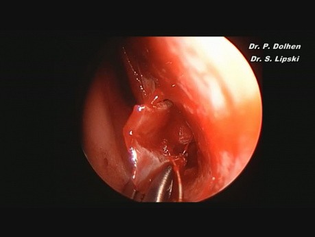 Septoplasty and Turbinectomy