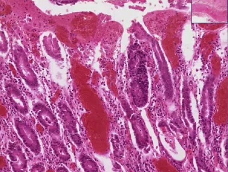 Bacillary dysentery