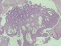 Case on Multiple Adenomas (large polyps) of the Rectum (34 of 37)